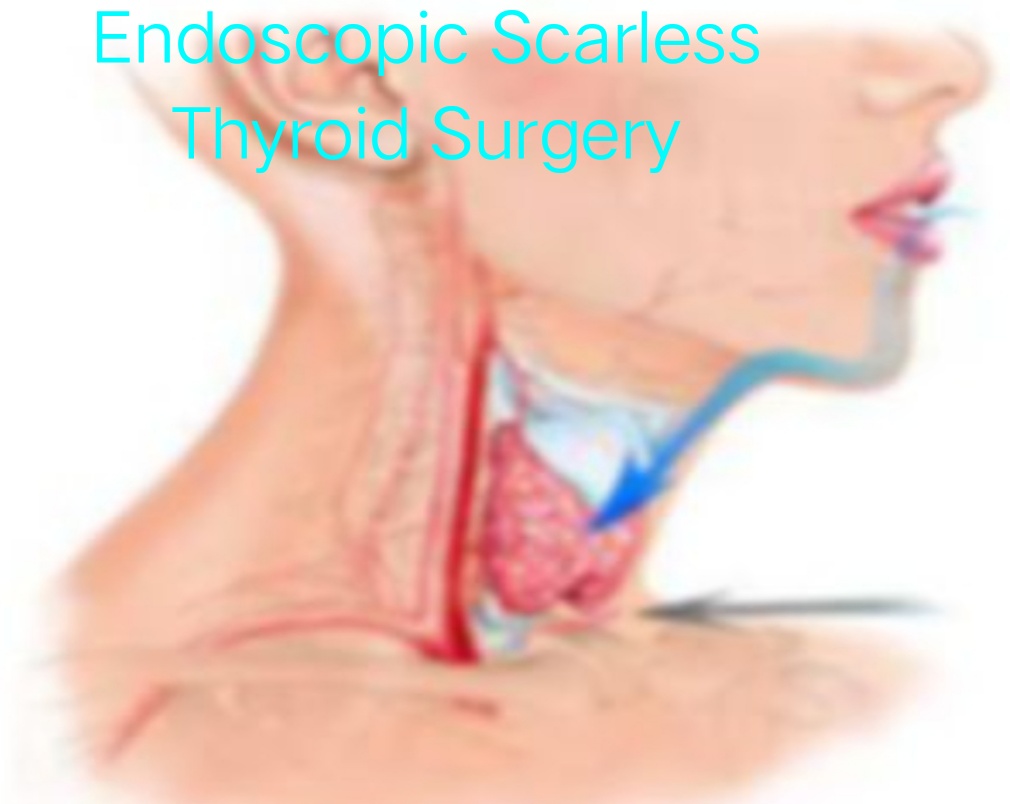 Trans-Oral Endoscopic Thyroid Surgery